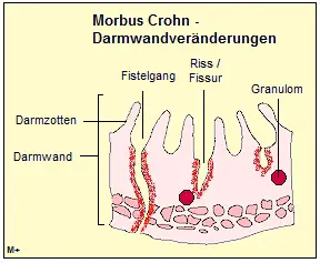 Darmwandvernderungen bei Morbus Crohn