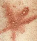 Typisches streifenfrmiges Muster bei Wiesengrserdermatitis.