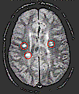 Die rot umrandeten weien Flecken zeigen Vernderungen durch Plaques der Multiple Sklerose an.
