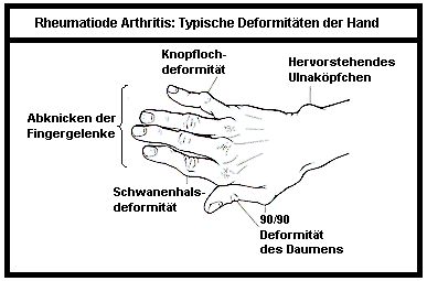 Typische Deformitten der Hand bei RA.