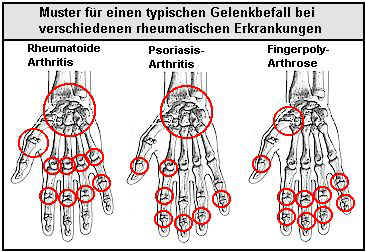 Typischer Gelenkbefall der Hnde bei verschiedenen rheumatischen Krankheitsbildern.