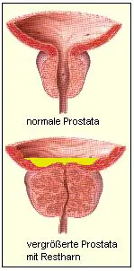 Vergrerte Prostata mit Restharn