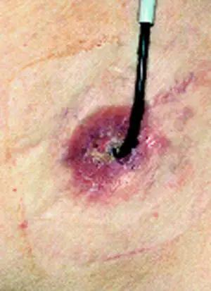 Ureter-Haut-Fistel mit Schiene, die peristomale Haut entzndlich verndert.